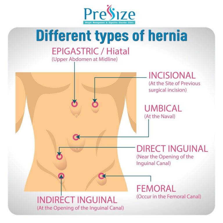 Hernia Treatment In Pune