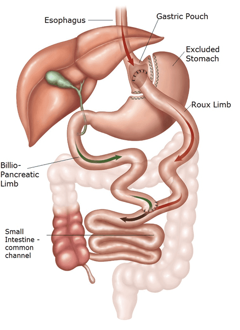 laproscopic gastric bypass